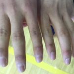 Jeremy’s been training for the seal hop event all year and has the calluses to prove it. (Photo by Emily Kwong/KCAW)